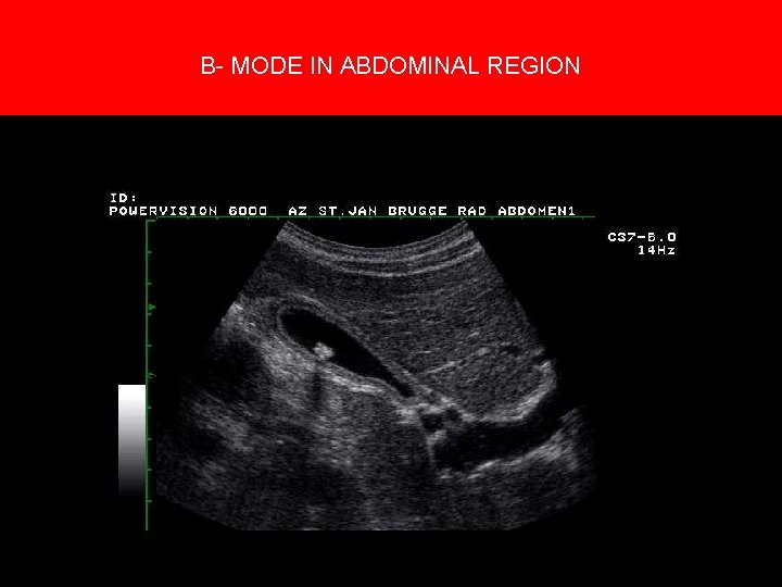 5. Creation of an image B- MODE IN ABDOMINAL REGION 5. Creation of an image B- MODE IN ABDOMINAL REGION