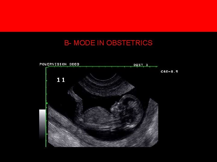 5. Creation of an image B- MODE IN OBSTETRICS 5. Creation of an image B- MODE IN OBSTETRICS