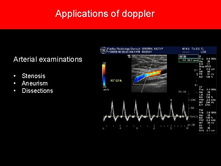 Applications of doppler Arterial examinations • Stenosis • Aneurism • Dissections Applications of doppler Arterial examinations • Stenosis • Aneurism • Dissections