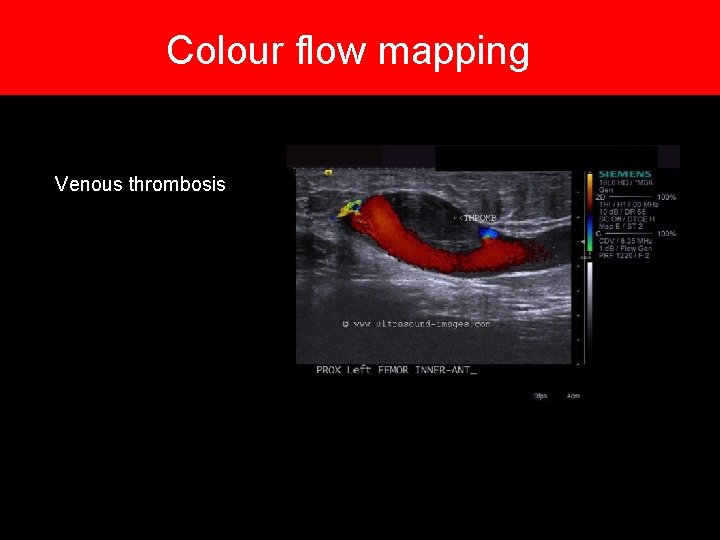 Colour flow mapping Venous thrombosis Colour flow mapping Venous thrombosis