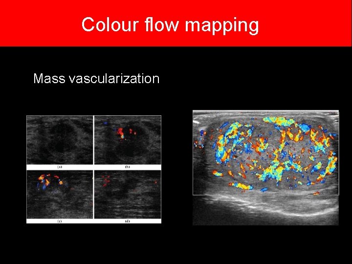 Colour flow mapping Mass vascularization Colour flow mapping Mass vascularization