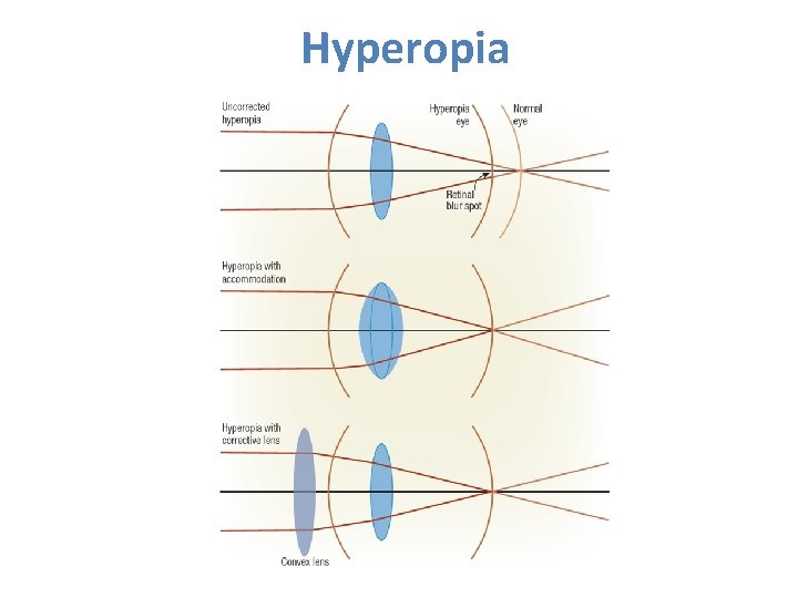 Hyperopia 