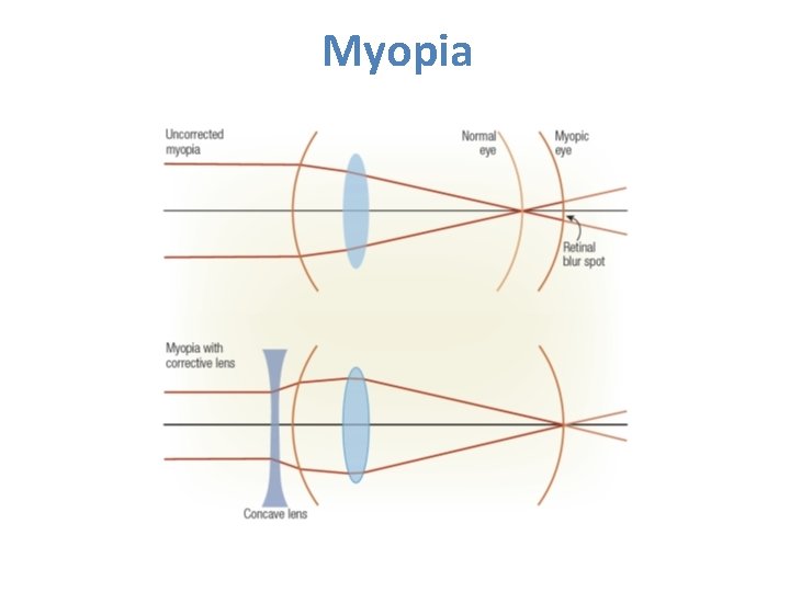 Myopia Myopia