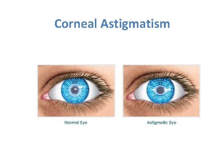 Corneal Astigmatism Corneal Astigmatism