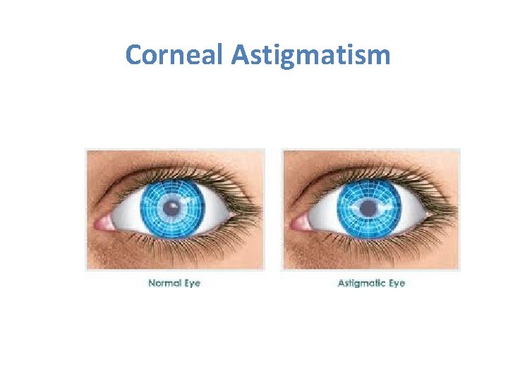 Corneal Astigmatism 