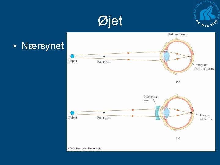 Øjet • Nærsynet 