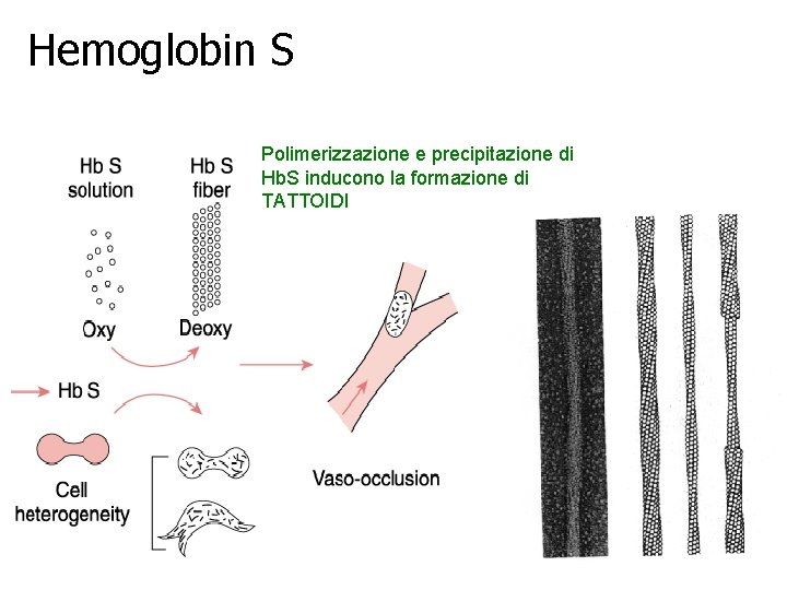 Hemoglobin S Polimerizzazione e precipitazione di Hb. S inducono la formazione di TATTOIDI Hemoglobin S Polimerizzazione e precipitazione di Hb. S inducono la formazione di TATTOIDI