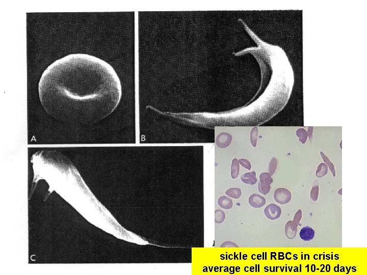 sickle cell RBCs in crisis average cell survival 10 -20 days 