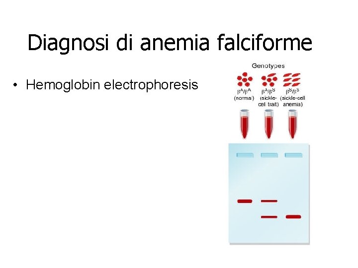 Diagnosi di anemia falciforme • Hemoglobin electrophoresis Diagnosi di anemia falciforme • Hemoglobin electrophoresis
