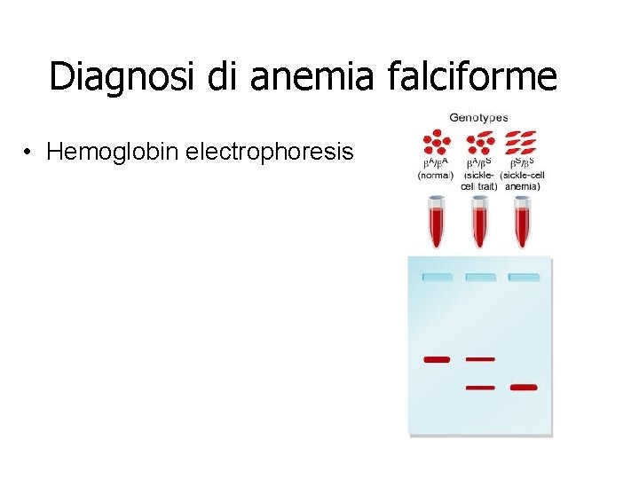 Diagnosi di anemia falciforme • Hemoglobin electrophoresis 