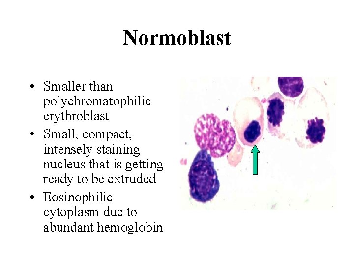 Normoblast • Smaller than polychromatophilic erythroblast • Small, compact, intensely staining nucleus that is Normoblast • Smaller than polychromatophilic erythroblast • Small, compact, intensely staining nucleus that is