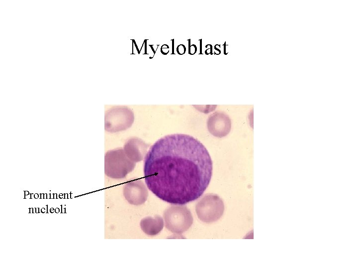 Myeloblast Prominent nucleoli  Myeloblast Prominent nucleoli
