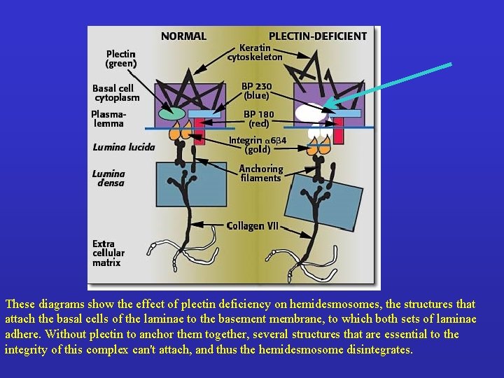 These diagrams show the effect of plectin deficiency on hemidesmosomes, the structures that attach