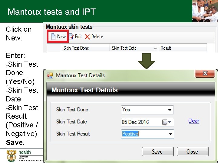 Mantoux tests and IPT Click on New. Enter: -Skin Test Done (Yes/No) -Skin Test