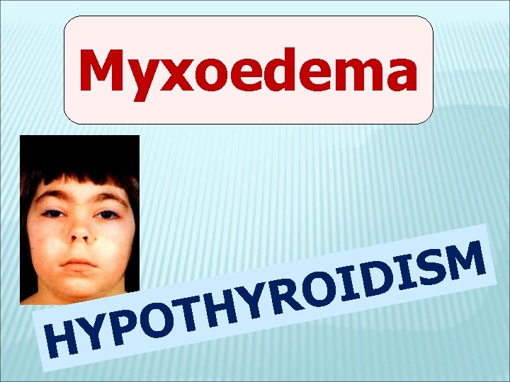 Myxoedema P Y H R Y H T O M S I D I