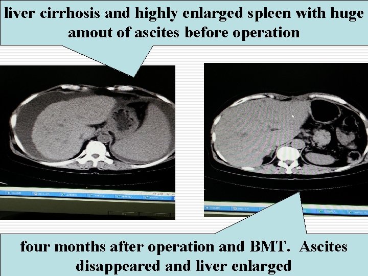 liver cirrhosis and highly enlarged spleen with huge amout of ascites before operation four