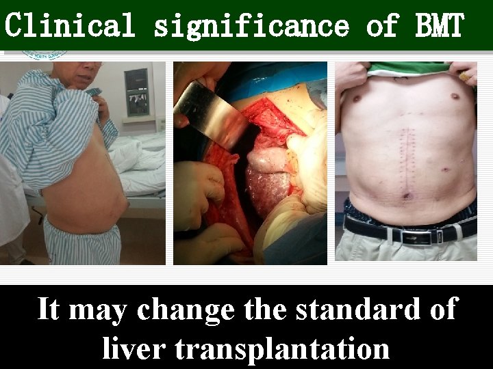 Clinical significance of BMT It may change the standard of liver transplantation 