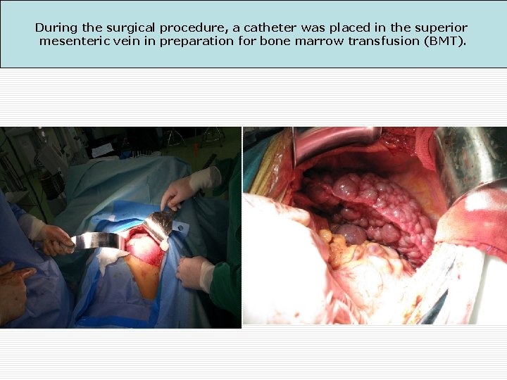 During the surgical procedure, a catheter was placed in the superior mesenteric vein in