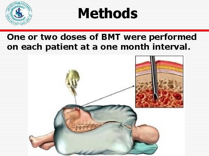 Methods One or two doses of BMT were performed on each patient at a