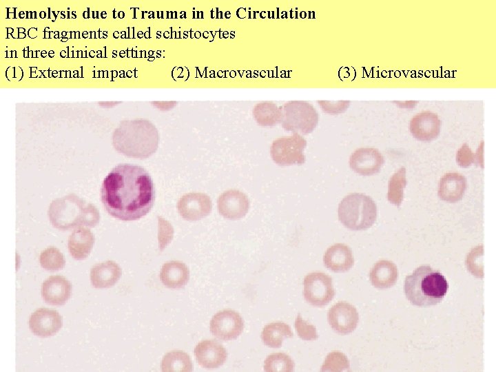 Hemolysis due to Trauma in the Circulation RBC fragments called schistocytes in three clinical