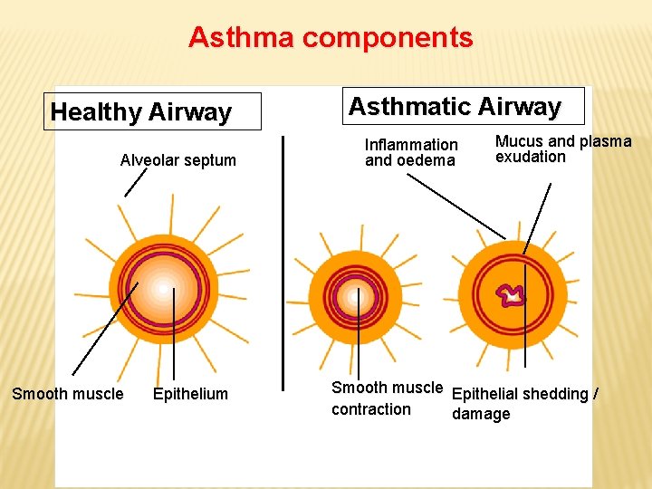 Asthma components Healthy Airway Alveolar septum Smooth muscle Epithelium Asthmatic Airway Inflammation and oedema
