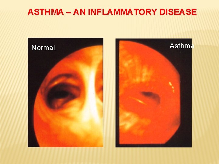 ASTHMA – AN INFLAMMATORY DISEASE Normal Asthma 