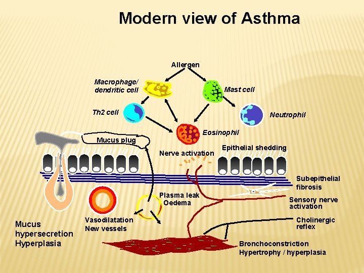 Modern view of Asthma Allergen Macrophage/ dendritic cell Mast cell Th 2 cell Neutrophil