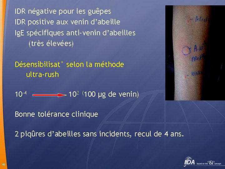 IDR négative pour les guêpes IDR positive aux venin d’abeille Ig. E spécifiques anti-venin