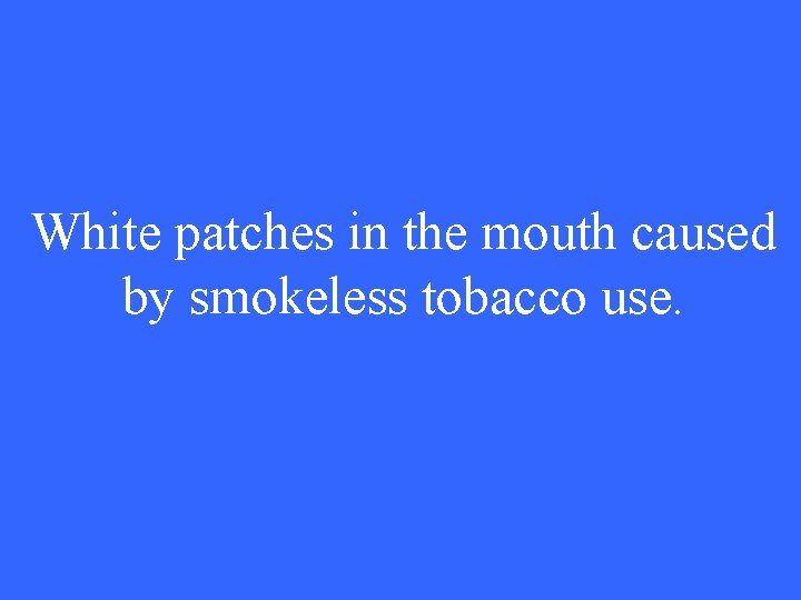 White patches in the mouth caused by smokeless tobacco use. 