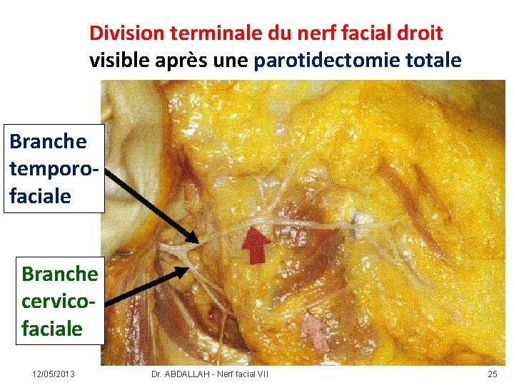 Division terminale du nerf facial droit visible après une parotidectomie totale Branche temporofaciale Branche