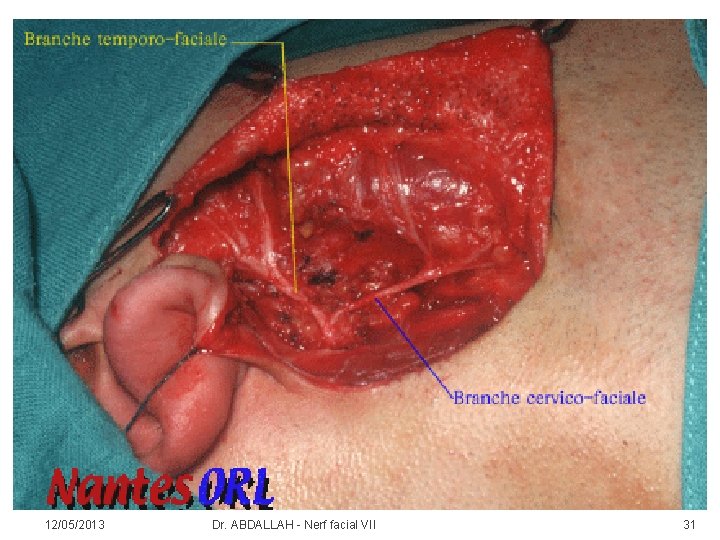 12/05/2013 Dr. ABDALLAH - Nerf facial VII 31 