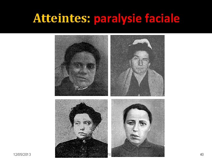 Atteintes: paralysie faciale 12/05/2013 Dr. ABDALLAH - Nerf facial VII 40 