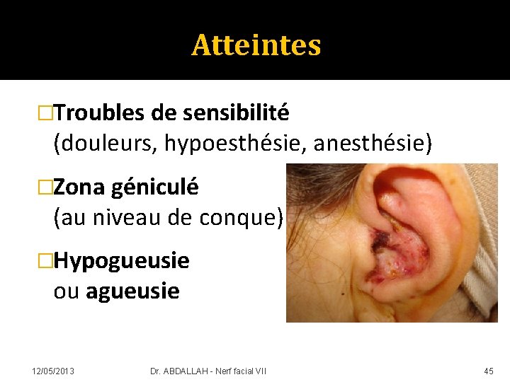 Atteintes �Troubles de sensibilité (douleurs, hypoesthésie, anesthésie) �Zona géniculé (au niveau de conque) �Hypogueusie