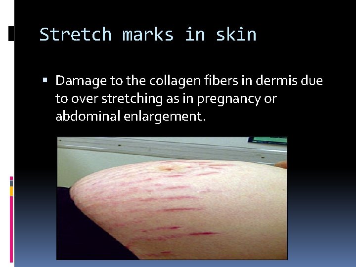 Stretch marks in skin Damage to the collagen fibers in dermis due to over Stretch marks in skin Damage to the collagen fibers in dermis due to over