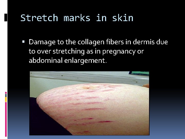 Stretch marks in skin Damage to the collagen fibers in dermis due to over