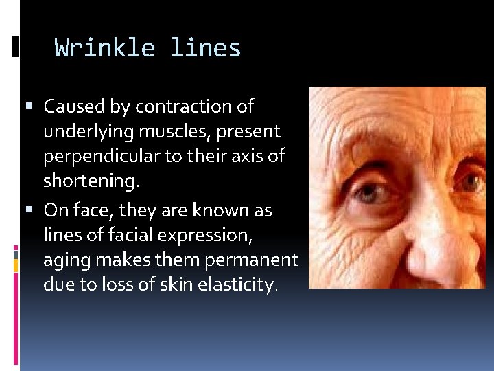 Wrinkle lines Caused by contraction of underlying muscles, present perpendicular to their axis of Wrinkle lines Caused by contraction of underlying muscles, present perpendicular to their axis of