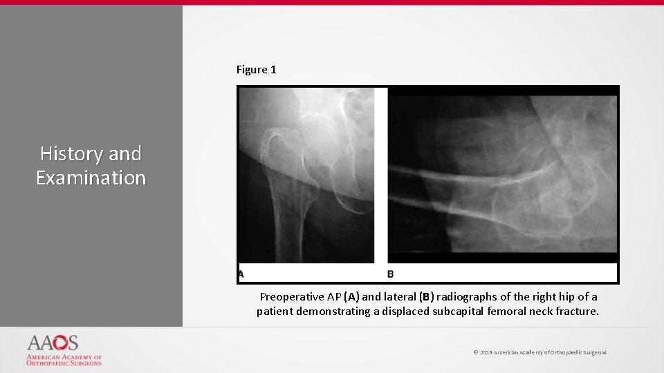 Figure 1 History and Examination Preoperative AP (A) and lateral (B) radiographs of the