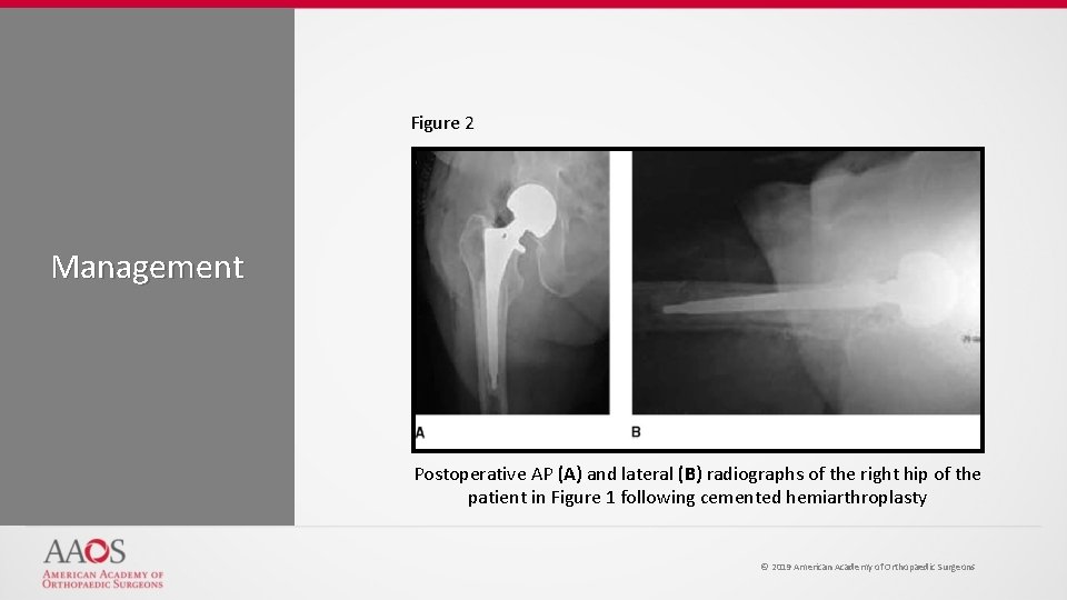 Figure 2 Management Postoperative AP (A) and lateral (B) radiographs of the right hip