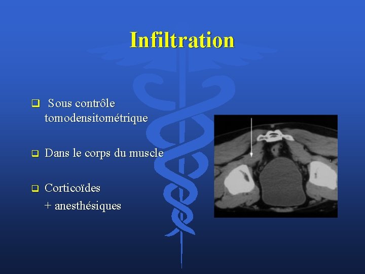 Infiltration q Sous contrôle tomodensitométrique q Dans le corps du muscle q Corticoïdes +