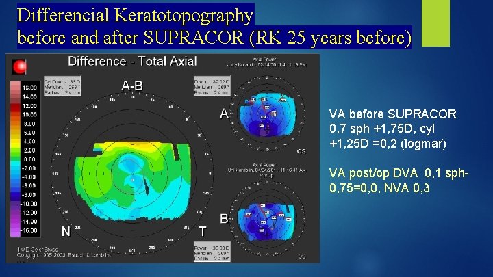 Differencial Keratotopography before and after SUPRACOR (RK 25 years before) VA before SUPRACOR 0,