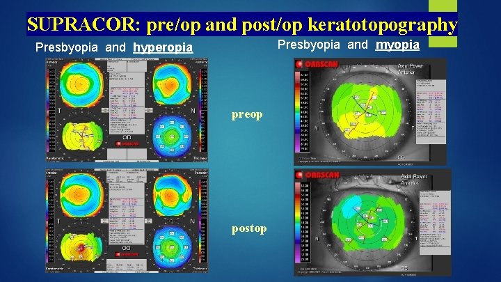 SUPRACOR: pre/op and post/op keratotopography Presbyopia and myopia Presbyopia and hyperopia preop postop 