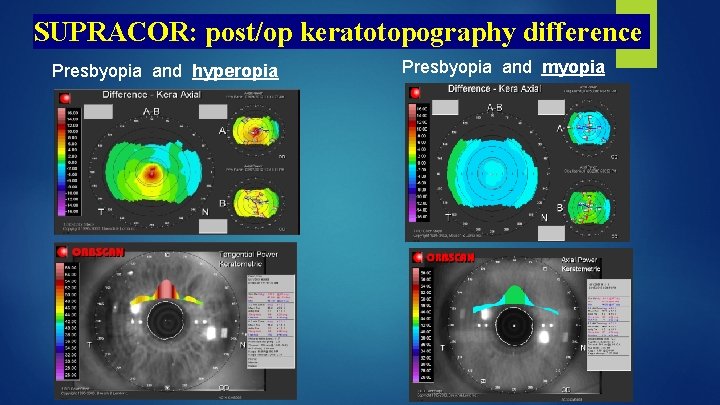 SUPRACOR: post/op keratotopography difference Presbyopia and hyperopia . Presbyopia and myopia 
