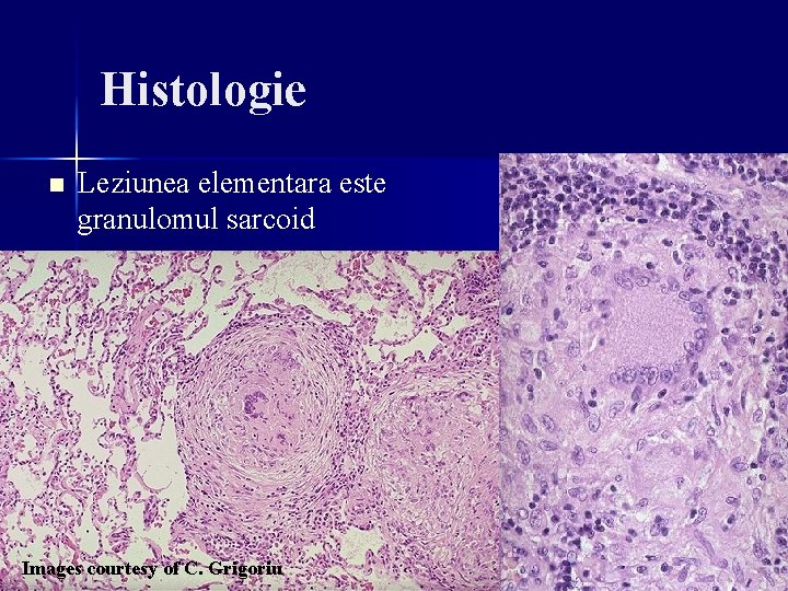 Histologie n Leziunea elementara este granulomul sarcoid Images courtesy of C. Grigoriu Histologie n Leziunea elementara este granulomul sarcoid Images courtesy of C. Grigoriu