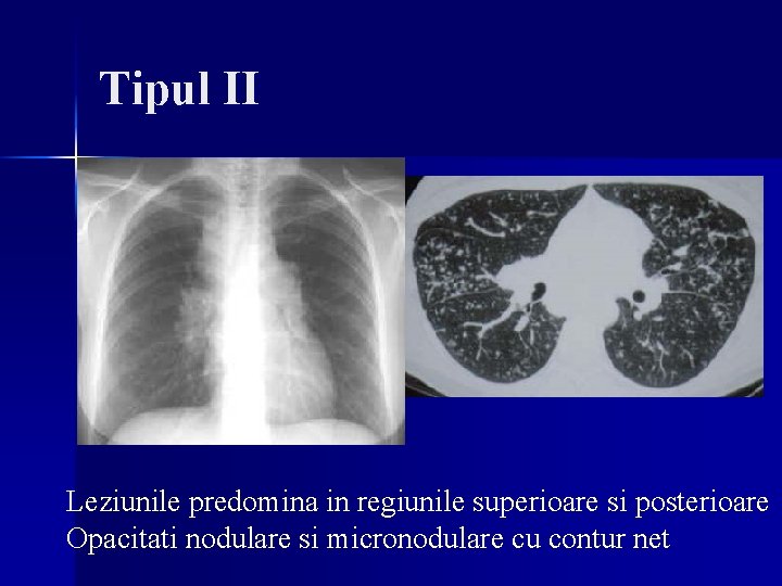 Tipul II Leziunile predomina in regiunile superioare si posterioare Opacitati nodulare si micronodulare cu Tipul II Leziunile predomina in regiunile superioare si posterioare Opacitati nodulare si micronodulare cu