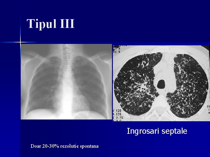 Tipul III Ingrosari septale Doar 20 -30% rezolutie spontana Tipul III Ingrosari septale Doar 20 -30% rezolutie spontana