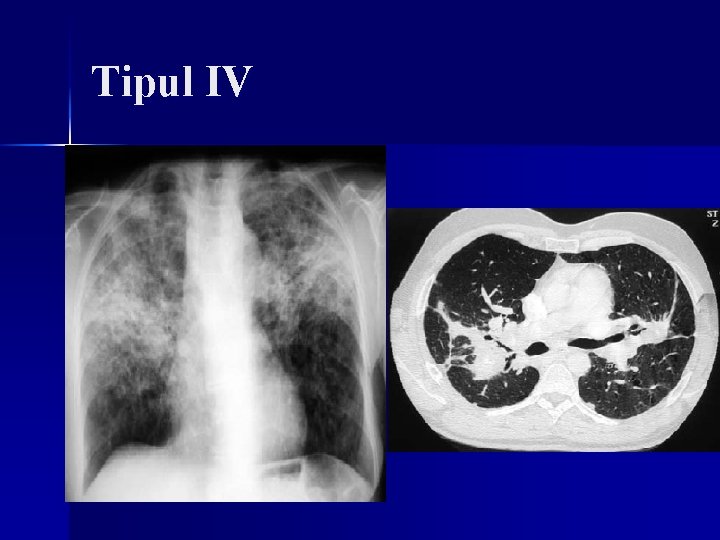 Tipul IV Tipul IV