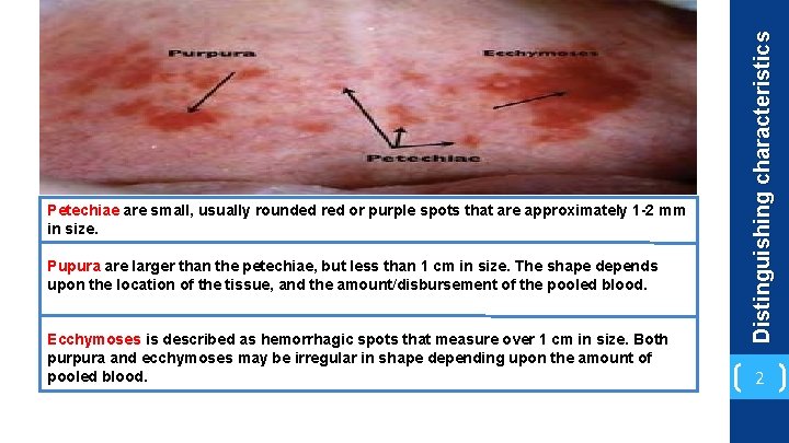 Pupura are larger than the petechiae, but less than 1 cm in size. The
