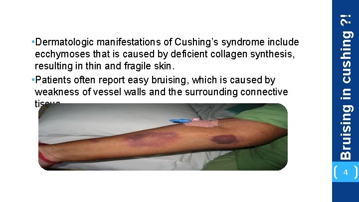 Bruising in cushing ? ! • Dermatologic manifestations of Cushing’s syndrome include ecchymoses that