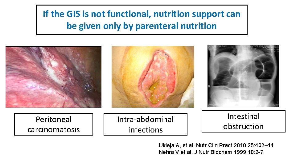 If the GIS is not functional, nutrition support can be given only by parenteral
