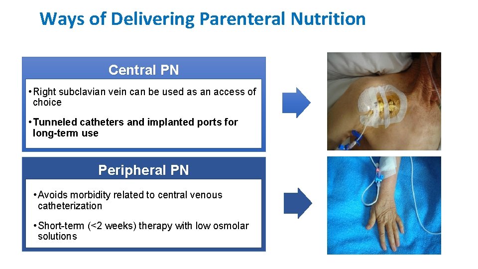Ways of Delivering Parenteral Nutrition Central PN • Right subclavian vein can be used Ways of Delivering Parenteral Nutrition Central PN • Right subclavian vein can be used